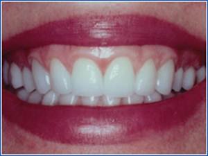 Description: http://www.cosmeticdentistglebe.com.au/wp-content/themes/kiseki/gallery/10-after.jpg